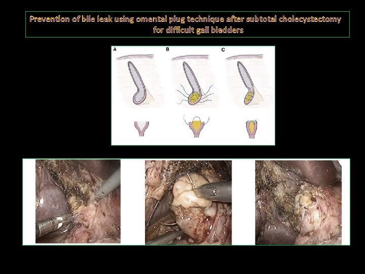 Prevention of bile leak using omental plug technique after subtotal cholecystectomy for difficult gall