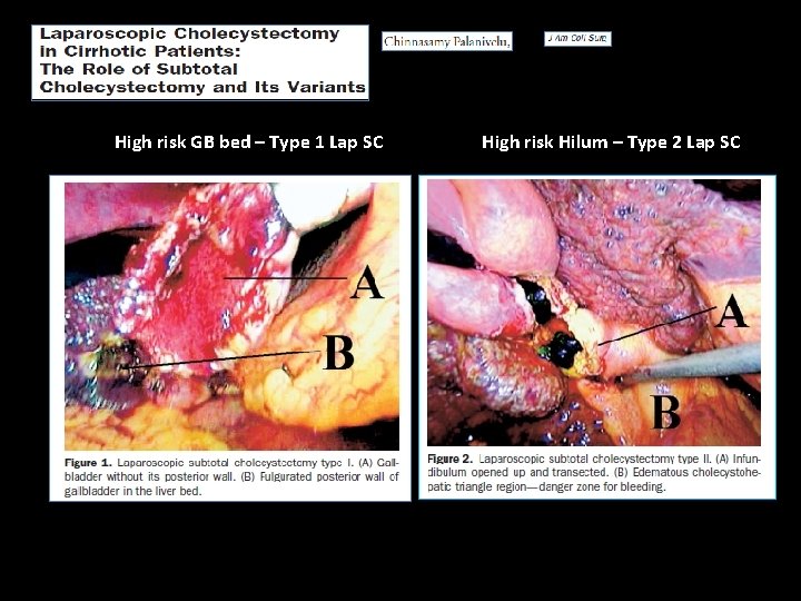 High risk GB bed – Type 1 Lap SC High risk Hilum – Type