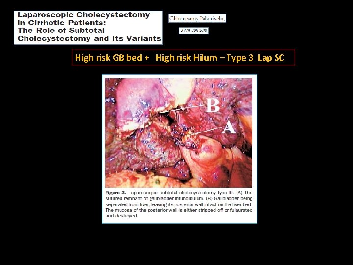 High risk GB bed + High risk Hilum – Type 3 Lap SC 