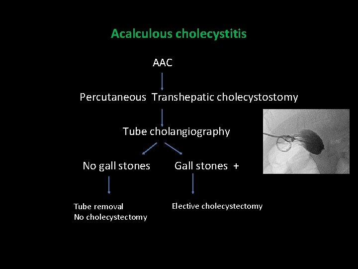 Acalculous cholecystitis AAC Percutaneous Transhepatic cholecystostomy Tube cholangiography No gall stones Tube removal No