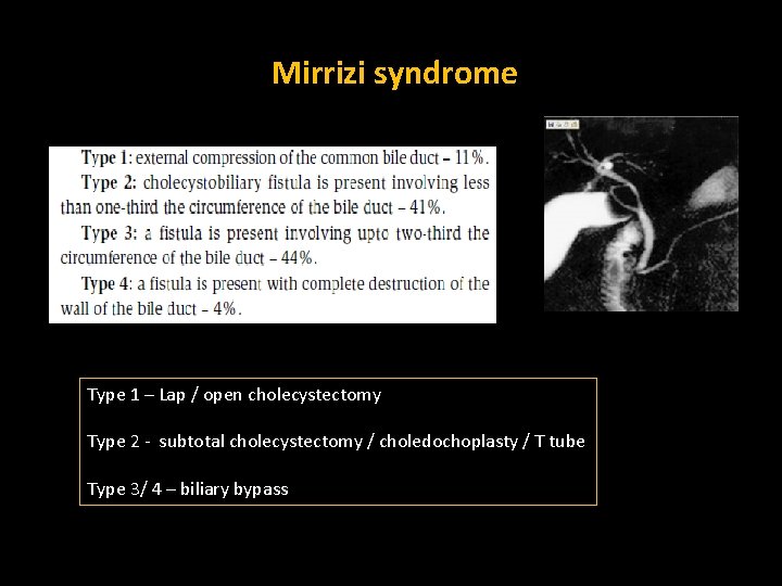 Mirrizi syndrome Type 1 – Lap / open cholecystectomy Type 2 - subtotal cholecystectomy