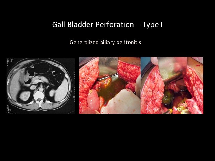 Gall Bladder Perforation - Type I Generalized biliary peritonitis 