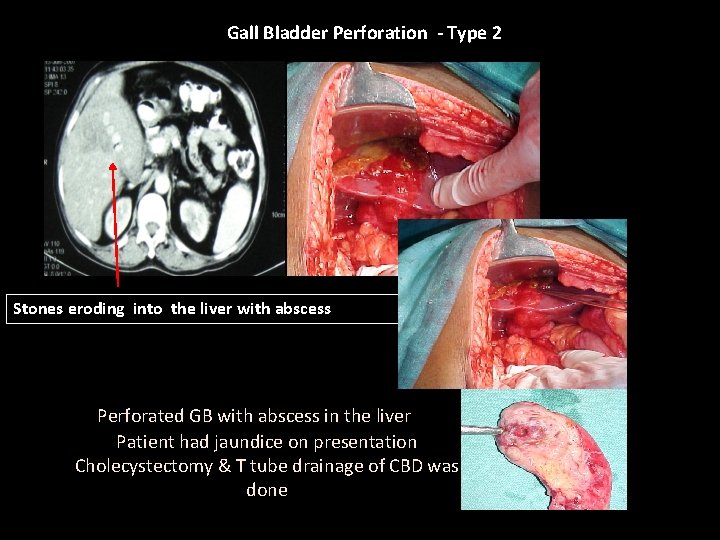 Gall Bladder Perforation - Type 2 Type II GBP Stones eroding into the liver