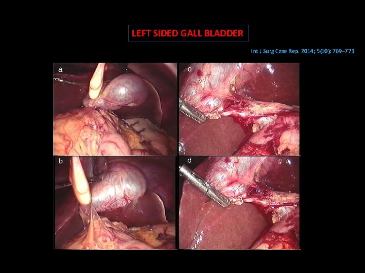 LEFT SIDED GALL BLADDER Methods of safe laparoscopic cholecystectomy for left-sided Int J Surg