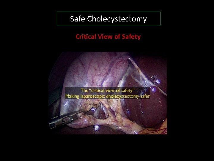 Safe Cholecystectomy Critical View of Safety 