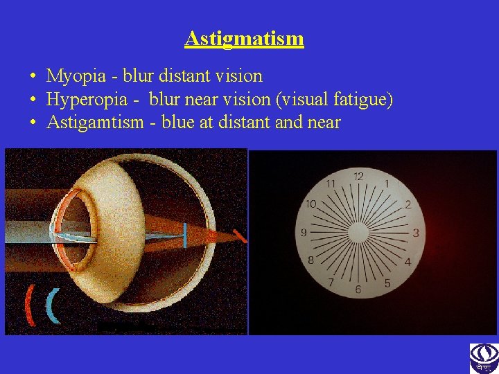 Astigmatism • Myopia - blur distant vision • Hyperopia - blur near vision (visual