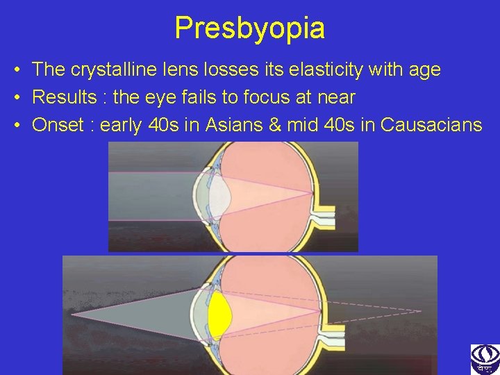 Presbyopia • The crystalline lens losses its elasticity with age • Results : the