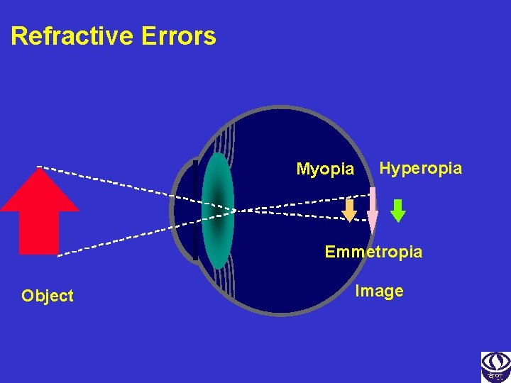 Refractive Errors Myopia Hyperopia Emmetropia Object Image 