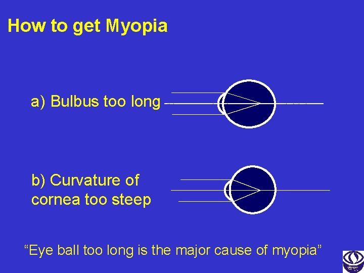 How to get Myopia a) Bulbus too long b) Curvature of cornea too steep