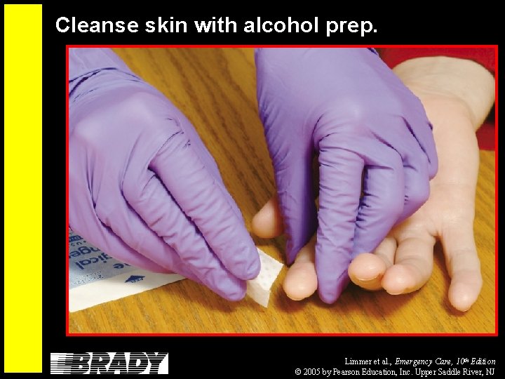 Cleanse skin with alcohol prep. Limmer et al. , Emergency Care, 10 th Edition