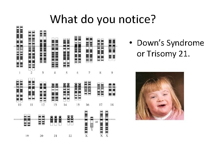 What do you notice? • Down’s Syndrome or Trisomy 21. 