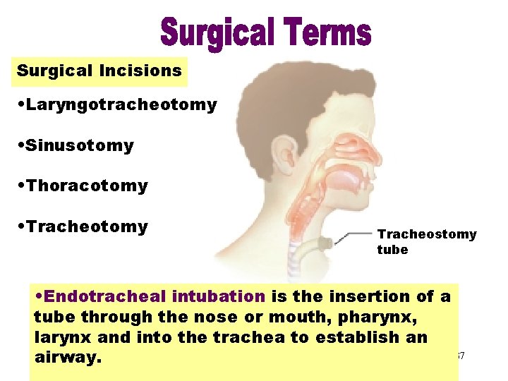 Surgical Incisions • Laryngotracheotomy • Sinusotomy • Thoracotomy • Tracheotomy Tracheostomy tube • Endotracheal