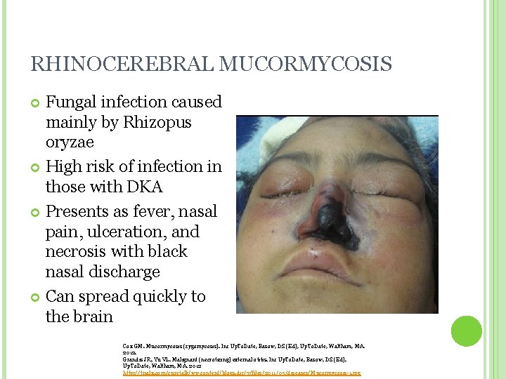 RHINOCEREBRAL MUCORMYCOSIS Fungal infection caused mainly by Rhizopus oryzae High risk of infection in RHINOCEREBRAL MUCORMYCOSIS Fungal infection caused mainly by Rhizopus oryzae High risk of infection in