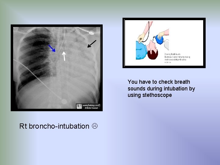 You have to check breath sounds during intubation by using stethoscope Rt broncho-intubation 