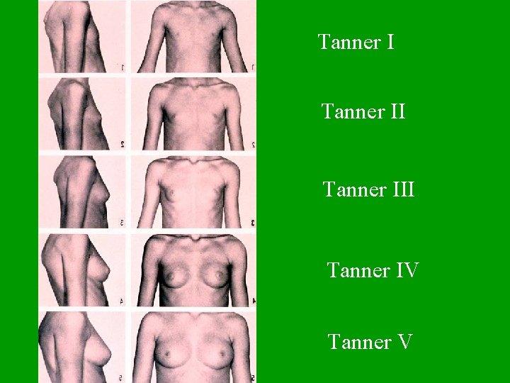 Tanner III Tanner IV Tanner V 