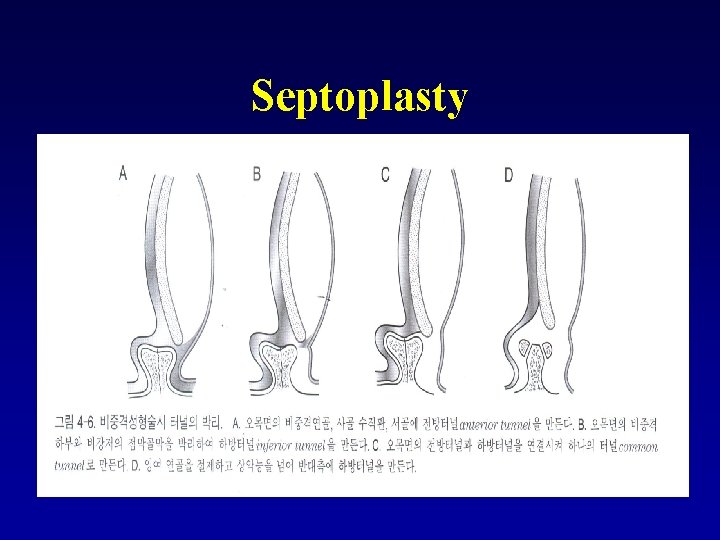 Septoplasty 