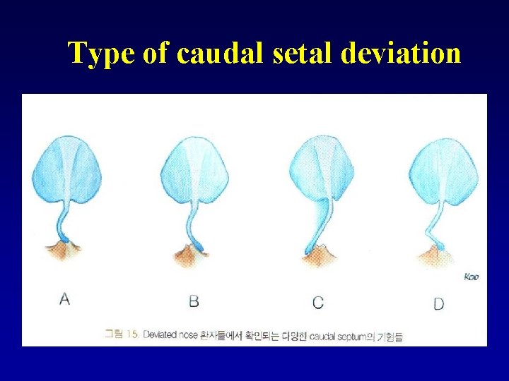 Type of caudal setal deviation 