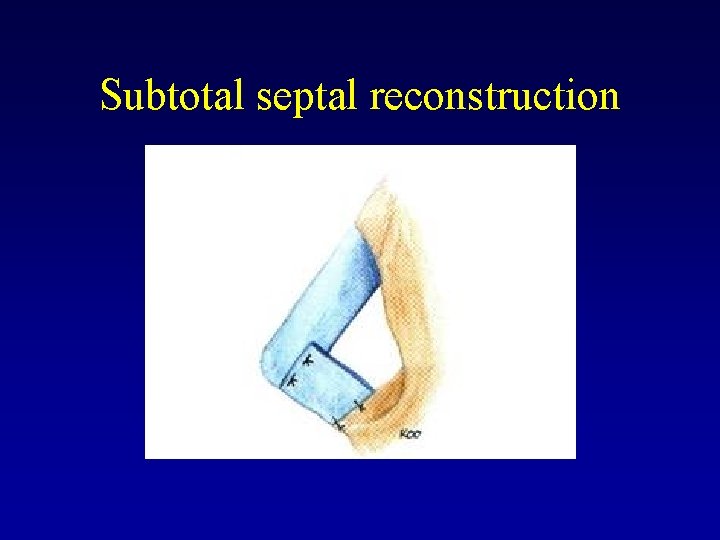 Subtotal septal reconstruction 