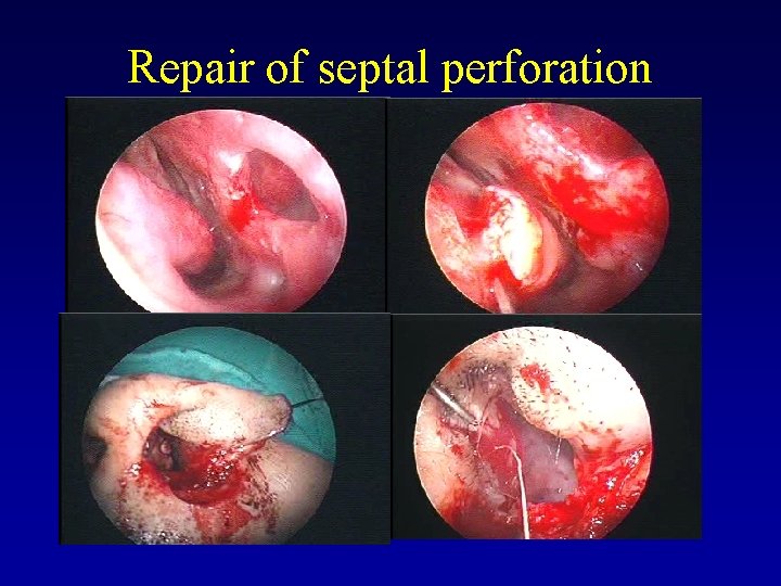 Repair of septal perforation 