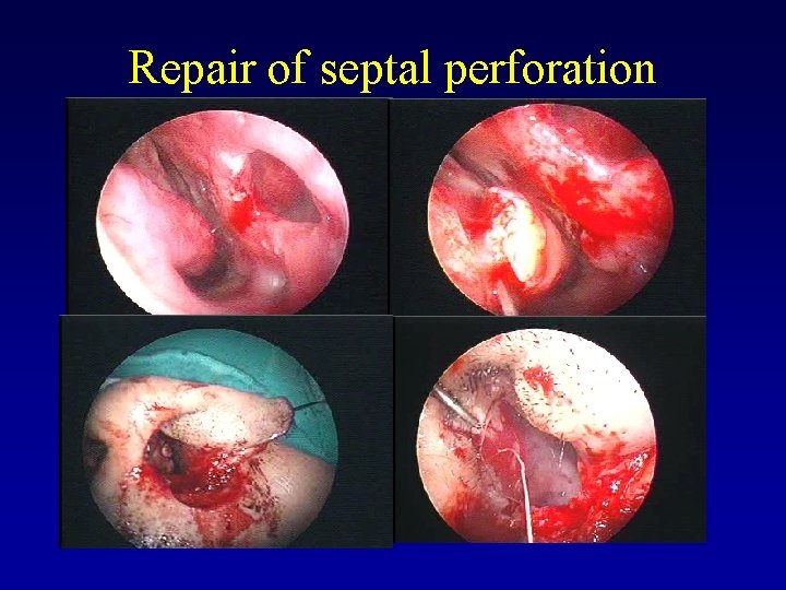 Repair of septal perforation 