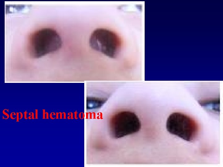 Septal hematoma 