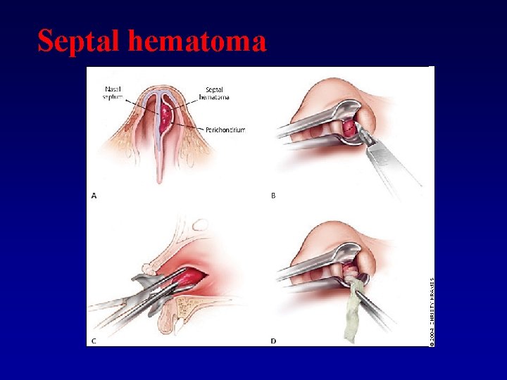 Septal hematoma 