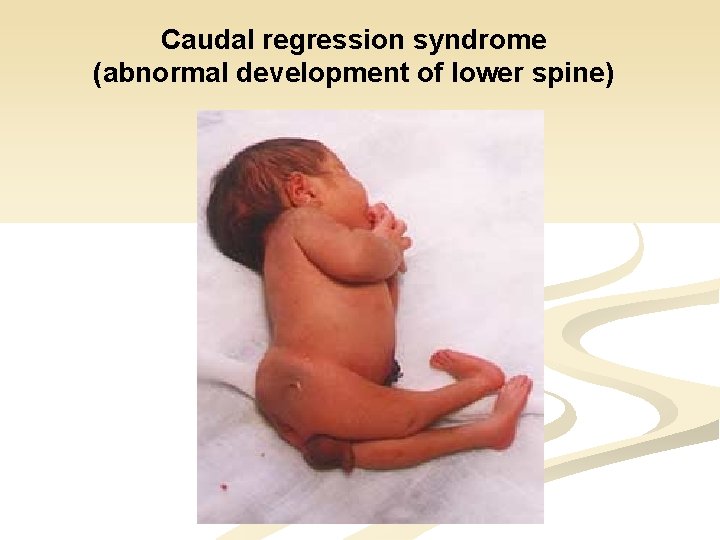 Caudal regression syndrome (abnormal development of lower spine) 