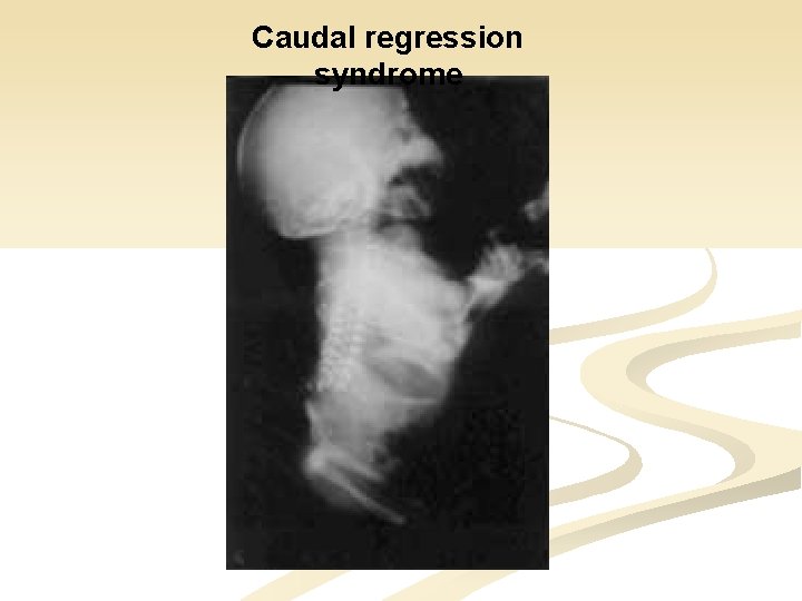 Caudal regression syndrome 