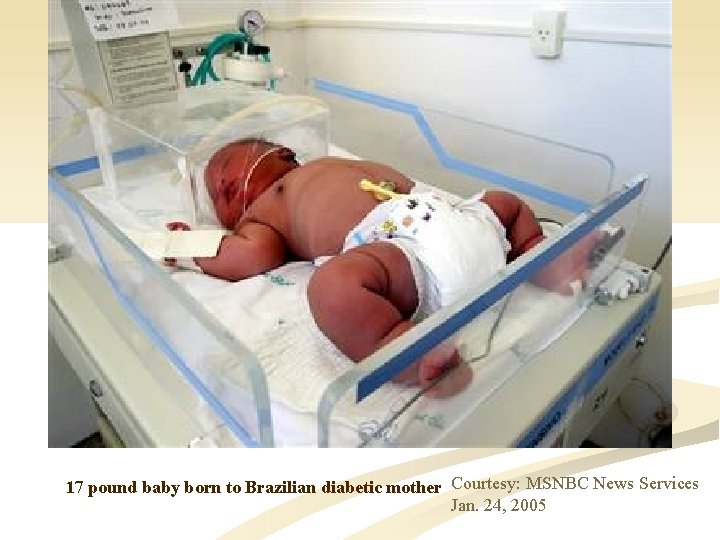  17 pound baby born to Brazilian diabetic mother Courtesy: MSNBC News Services Jan.