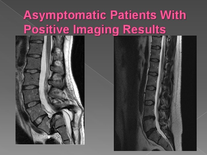 Asymptomatic Patients With Positive Imaging Results 