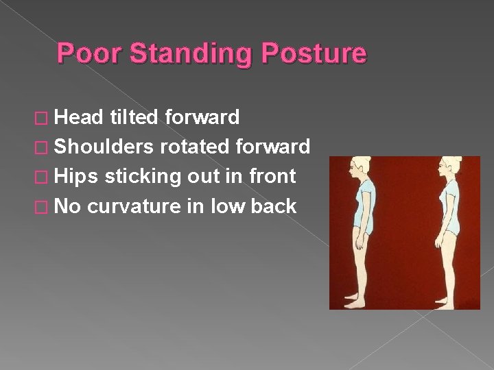 Poor Standing Posture � Head tilted forward � Shoulders rotated forward � Hips sticking