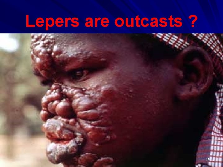 Lepers are outcasts ? 16 