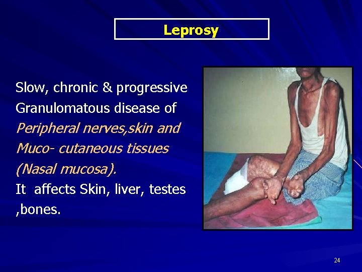 Leprosy Slow, chronic & progressive Granulomatous disease of Peripheral nerves, skin and Muco- cutaneous