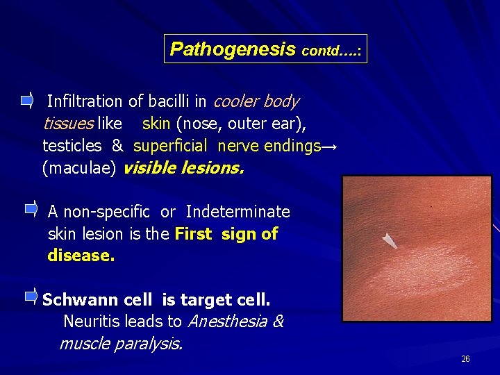 Pathogenesis contd…. : Infiltration of bacilli in cooler body tissues like skin (nose, outer