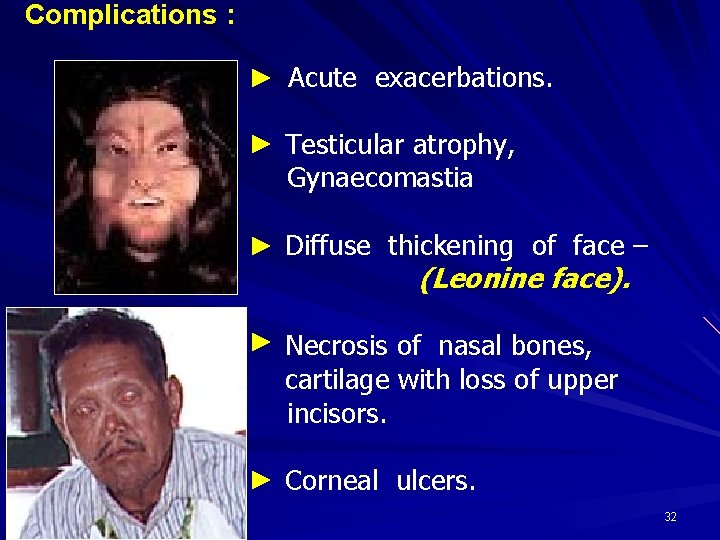 Complications : Acute exacerbations. Testicular atrophy, Gynaecomastia Diffuse thickening of face – (Leonine face).