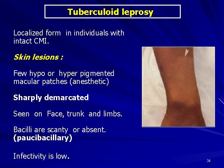 Tuberculoid leprosy Localized form in individuals with intact CMI. Skin lesions : Few hypo