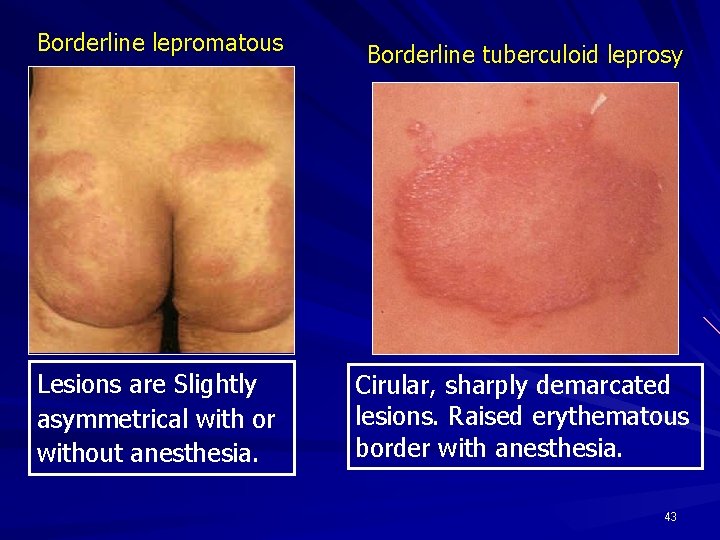 Borderline lepromatous Lesions are Slightly asymmetrical with or without anesthesia. Borderline tuberculoid leprosy Cirular,