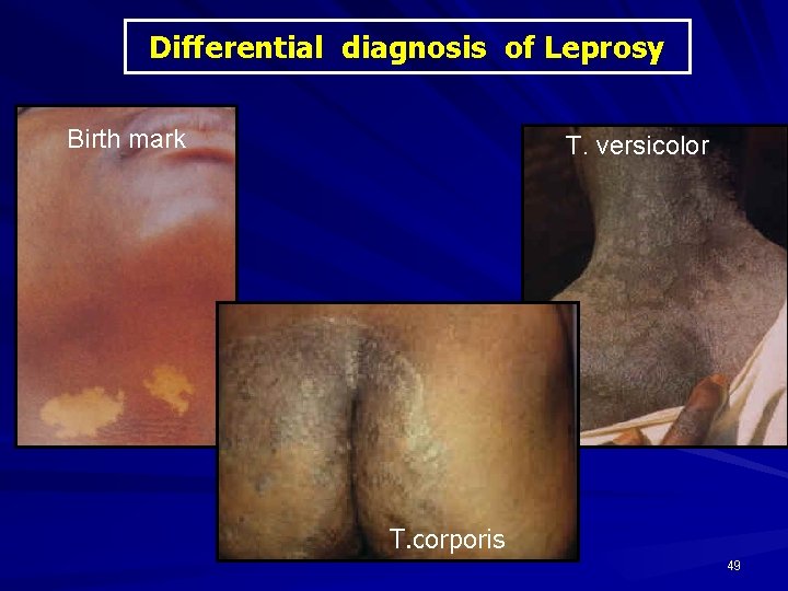 Differential diagnosis of Leprosy Birth mark T. versicolor T. corporis 49 