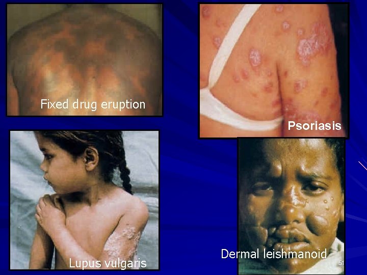 Fixed drug eruption Psoriasis Lupus vulgaris Dermal leishmanoid 51 