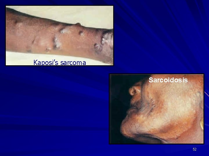 Kaposi’s sarcoma Sarcoidosis 52 