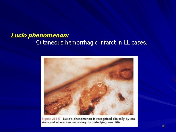 Lucio phenomenon: Cutaneous hemorrhagic infarct in LL cases. 60 