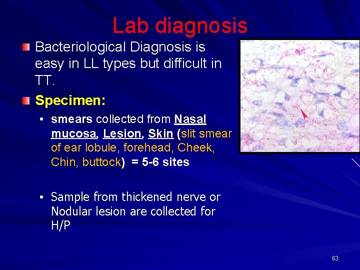 Lab diagnosis Bacteriological Diagnosis is easy in LL types but difficult in TT. Specimen: