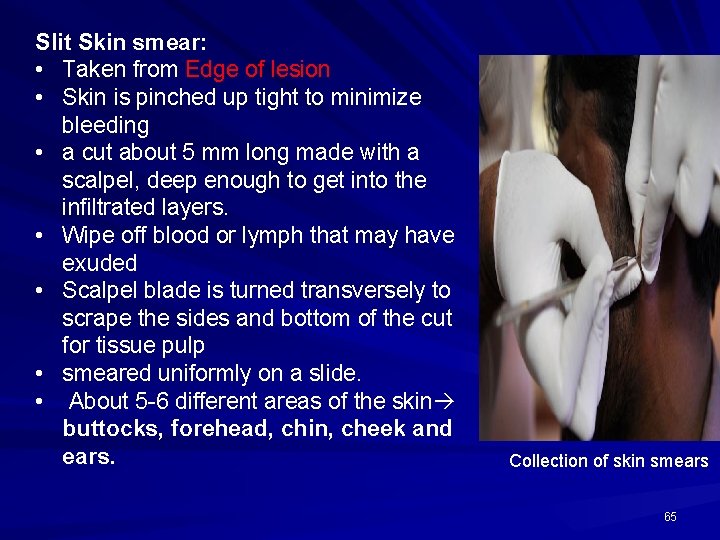 Slit Skin smear: • Taken from Edge of lesion • Skin is pinched up