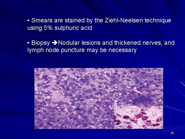  • Smears are stained by the Ziehl-Neelsen technique using 5% sulphuric acid. •