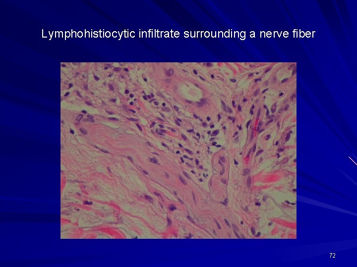 Lymphohistiocytic infiltrate surrounding a nerve fiber 72 