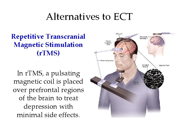 Alternatives to ECT Repetitive Transcranial Magnetic Stimulation (r. TMS) In r. TMS, a pulsating Alternatives to ECT Repetitive Transcranial Magnetic Stimulation (r. TMS) In r. TMS, a pulsating
