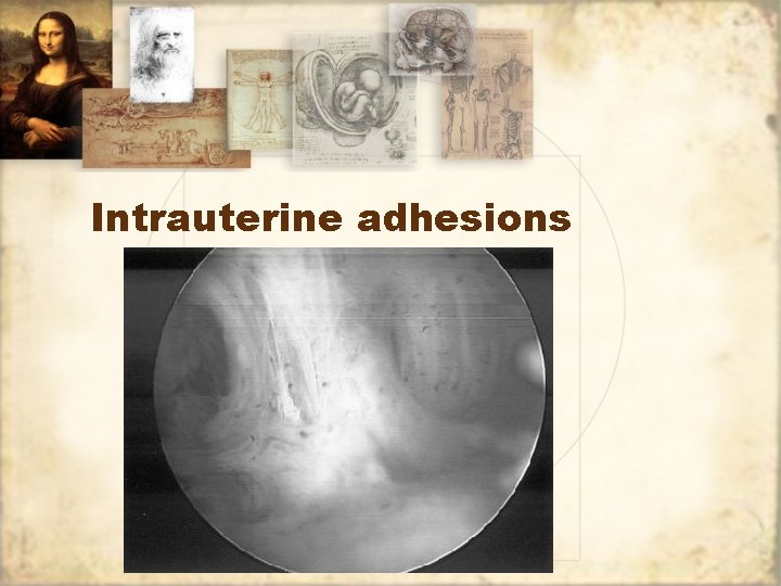 Intrauterine adhesions 