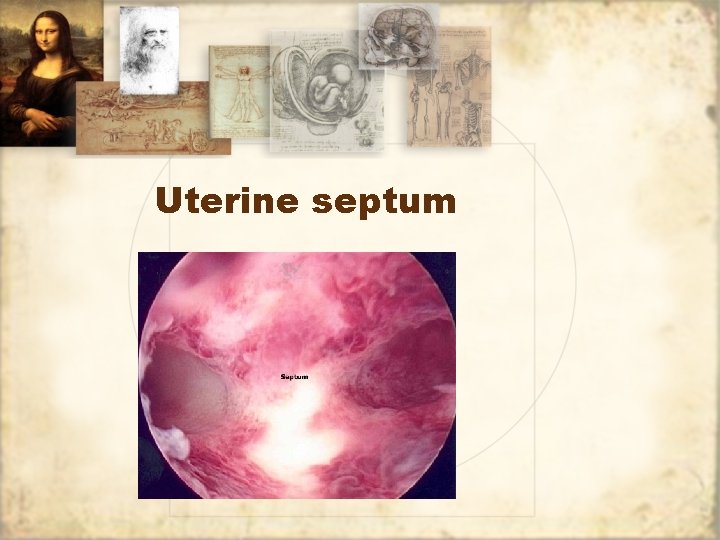 Uterine septum 