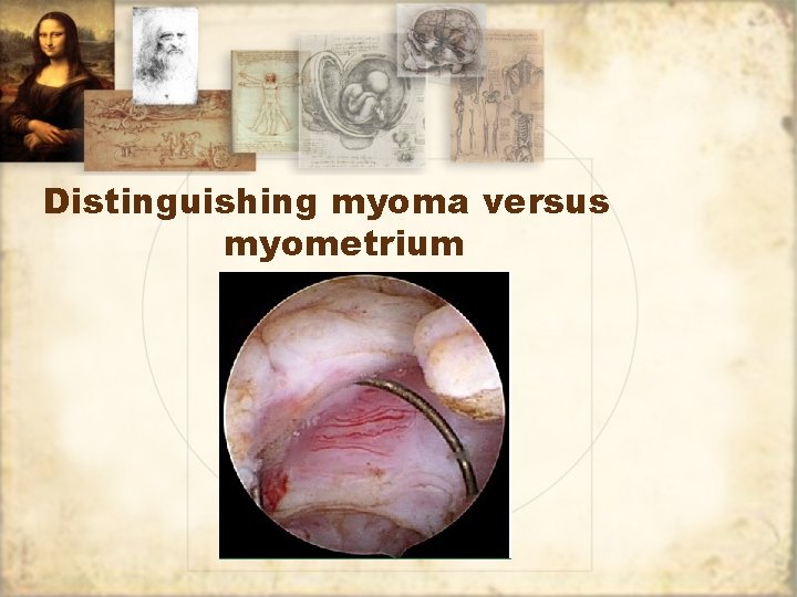 Distinguishing myoma versus myometrium 
