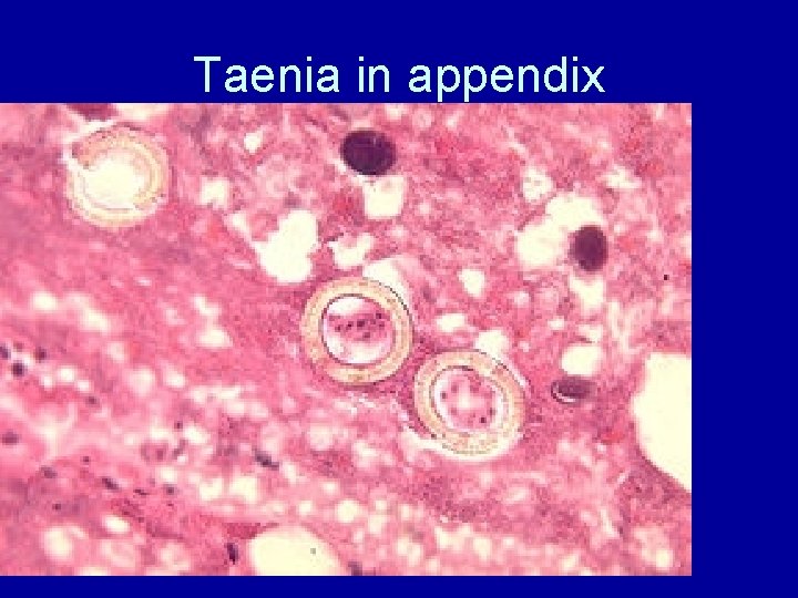 Taenia in appendix 
